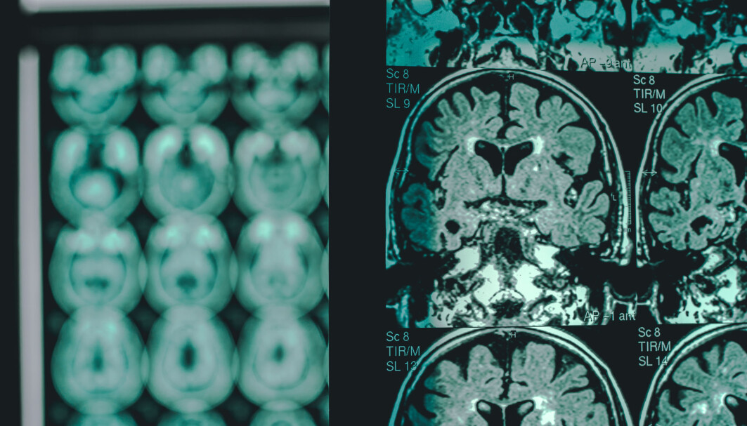 Until now, the only way to confirm that a person has Alzheimer's is by scanning the brain or from a spinal fluid sample. Now a simple blood test can detect the disease many years before the patient has noticeable symptoms. Until now, the only way to confirm that a person has Alzheimer's is by scanning the brain or from a spinal fluid sample. Now a simple blood test can detect the disease many years before the patient has noticeable symptoms.