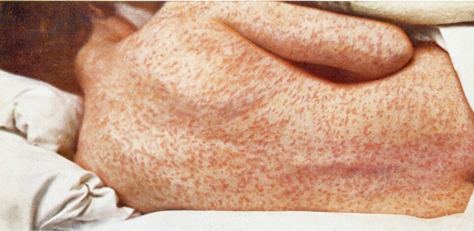 Measles causes a rash and fever and can be very serious for some people.