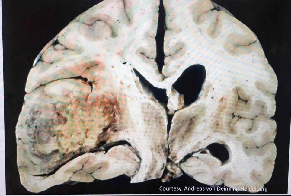This photo shows a brain tumour in the right side of the brain. This patient had their life prolonged for four months due to personalized medicine that works on her tumour.