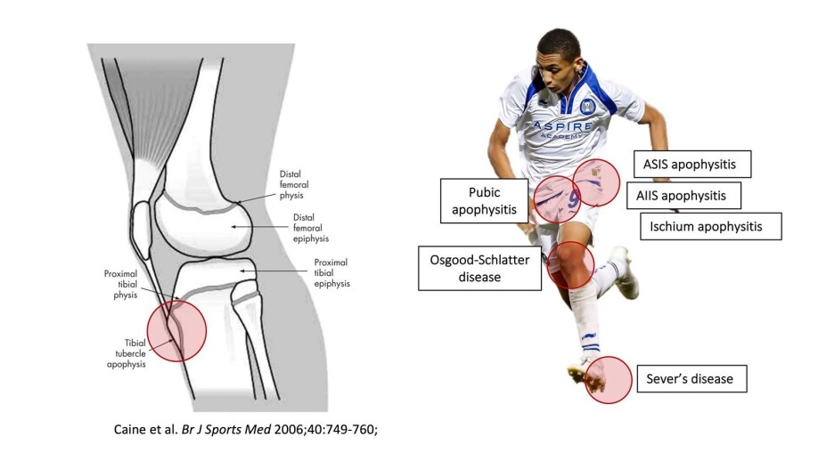 Different growth plates are particularly prone to injury during maturation. The tendon attachment for the quadriceps (thigh muscle) at the upper end of the tibia (lower leg) is one such place (see fact box).