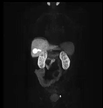 Here we see a PSMA-PET image of the pelvic region in a patient with suspected relapse after prostate cancer. In the image we see where the PSMA-tracer has been absorbed by the body, with absorption in the kidneys, liver, and salivary glands for healthy tissue. The small, round, bright spot at the bottom of the image shows signs of relapse of cancer. Here we see a PSMA-PET image of the pelvic region in a patient with suspected relapse after prostate cancer. In the image we see where the PSMA-tracer has been absorbed by the body, with absorption in the kidneys, liver, and salivary glands for healthy tissue. The small, round, bright spot at the bottom of the image shows signs of relapse of cancer.