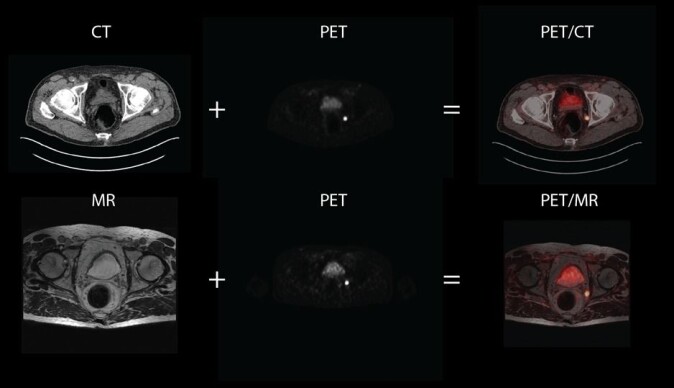 In the images we see MR and CT image slices of the pelvic region in a patient with suspected relapse after prostate cancer. It is difficult to see anatomical information from PET images, and they are therefore fused together with MR and CT images. In the pelvic region, which largely consists of soft tissue, MR provides more information than CT. In the images we see MR and CT image slices of the pelvic region in a patient with suspected relapse after prostate cancer. It is difficult to see anatomical information from PET images, and they are therefore fused together with MR and CT images. In the pelvic region, which largely consists of soft tissue, MR provides more information than CT.
