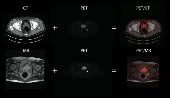 In the images we see MR and CT image slices of the pelvic region in a patient with suspected relapse after prostate cancer. It is difficult to see anatomical information from PET images, and they are therefore fused together with MR and CT images. In the pelvic region, which largely consists of soft tissue, MR provides more information than CT.