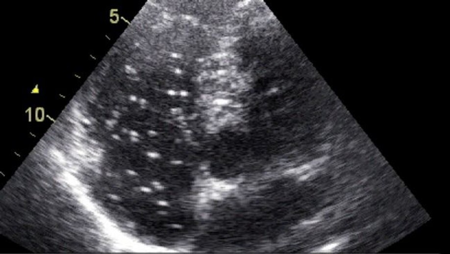 Decompression sickness occurs when you come up too fast from a dive. Gas bubbles form in the blood and tissues due to the reduced pressure. The white dots in the image are gas bubbles in the heart.