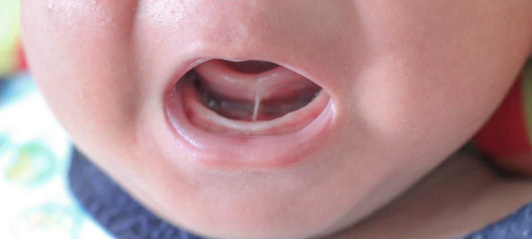 More caution about tongue-tie division urged by researchers