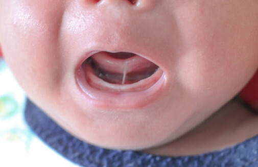 More caution about tongue-tie division urged by researchers