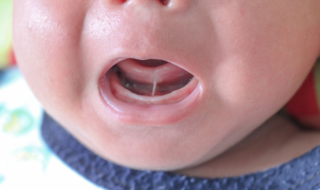 Tongue-tie in infants can create problems for breastfeeding. But not everyone agrees that cutting it is the answer. Tongue-tie in infants can create problems for breastfeeding. But not everyone agrees that cutting it is the answer.