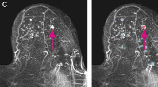 Tumours in breasts with dense tissue are more difficult to detect. Artificial intelligence can simplify the job, a new study shows. Tumours in breasts with dense tissue are more difficult to detect. Artificial intelligence can simplify the job, a new study shows.