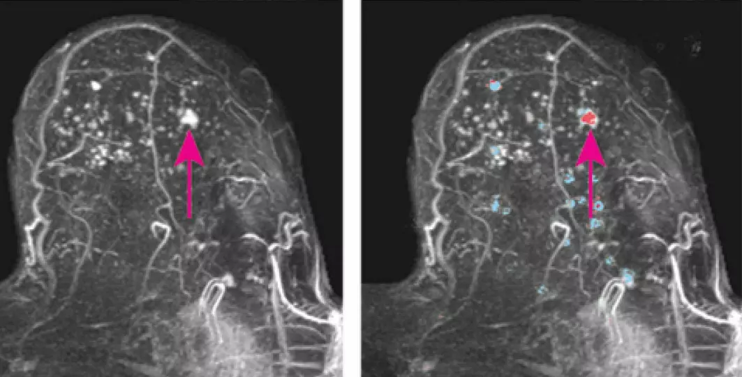 This MRI image of a breast shows what dense breast tissue looks like. The pink arrow shows a cancerous tumour. The image to the right shows areas of the breast that were assessed by artificial intelligence. Red means a high probability of cancer.