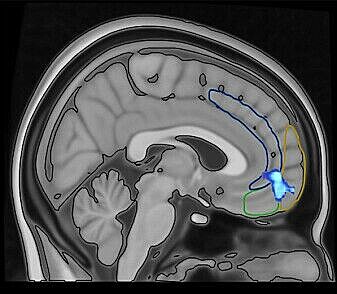 The light blue area in the lower, front part of the brain shows where the 'switch' is located — the one that sends signals that the voices should be turned on or off. The light blue area in the lower, front part of the brain shows where the 'switch' is located — the one that sends signals that the voices should be turned on or off.