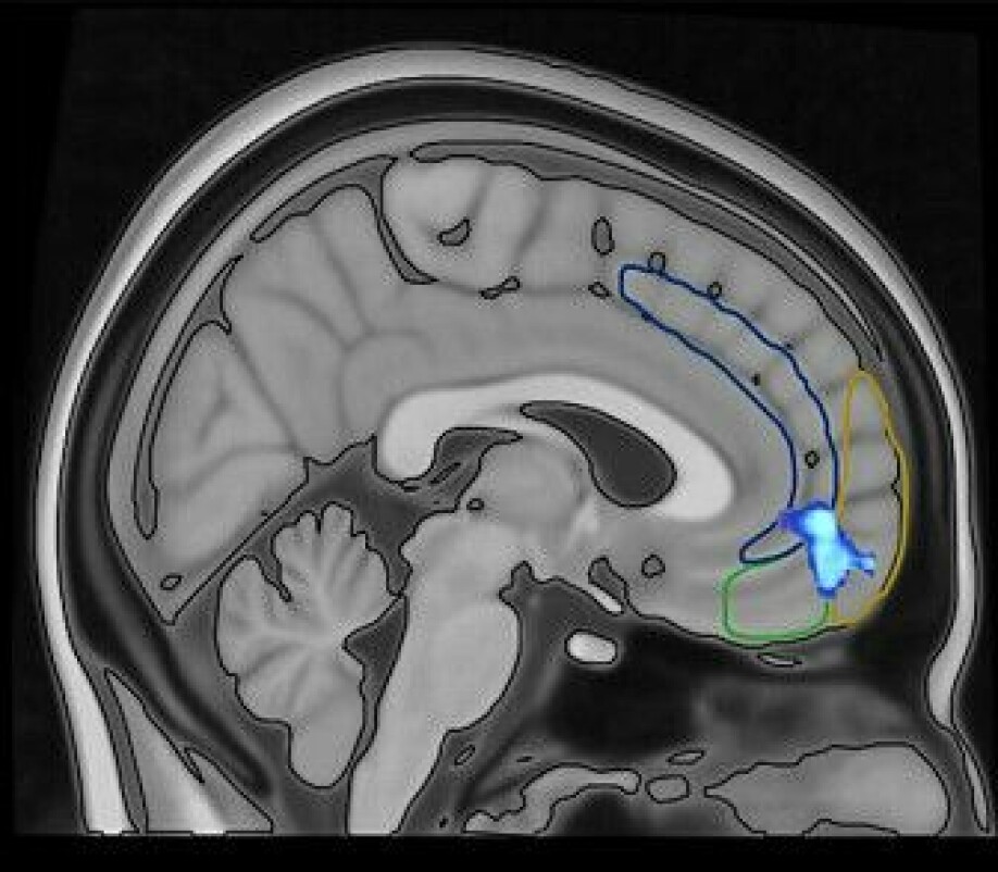 The light blue area in the lower, front part of the brain shows where the 'switch' is located — the one that sends signals that the voices should be turned on or off.
