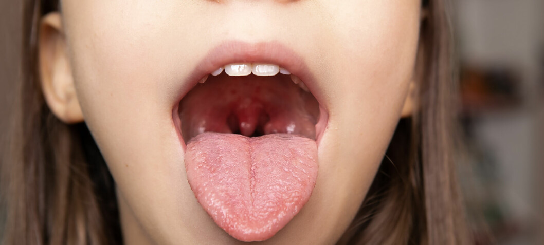 New treatment: Vaccines against hay fever could be injected directly into your tonsils