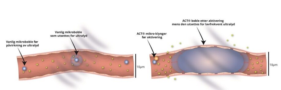 This illustration compares the size of ordinary microbubbles made for ultrasound imaging with a large ‘Acoustic Cluster Therapy’ bubble that is in direct contact with large parts of the blood vessel wall.