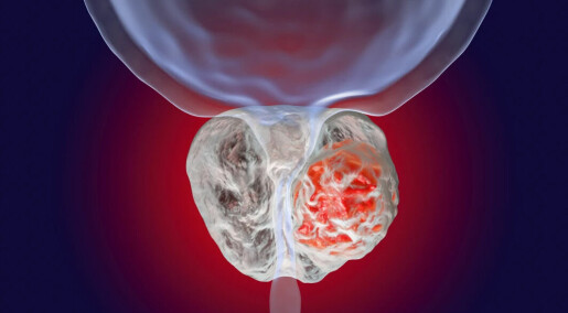 New test method for prostate cancer lowers the risk of infection – making antibiotics unnecessary New test method for prostate cancer lowers the risk of infection – making antibiotics unnecessary