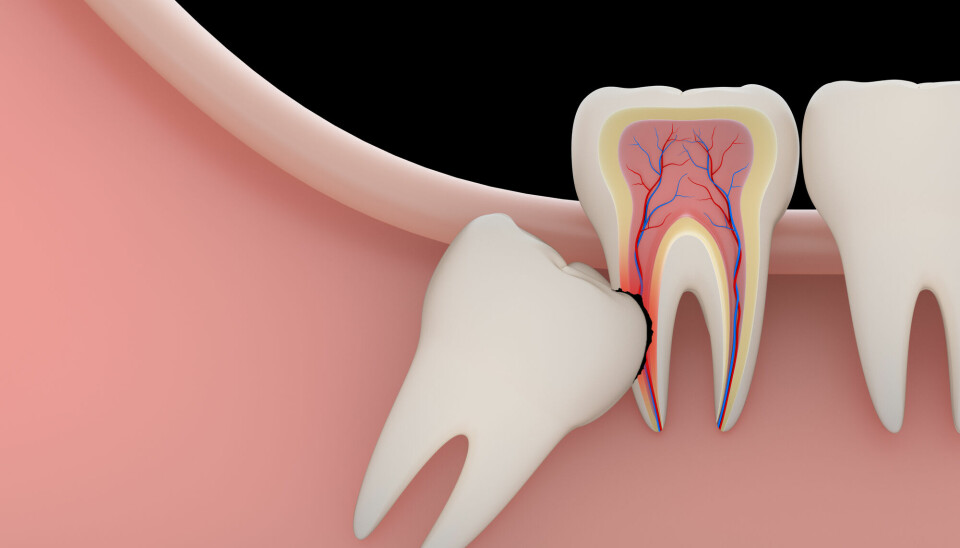 Wisdom teeth are just normal molars, but as our diet changed, our jaws became smaller. For some, this means that having wisdom teeth is a real headache.