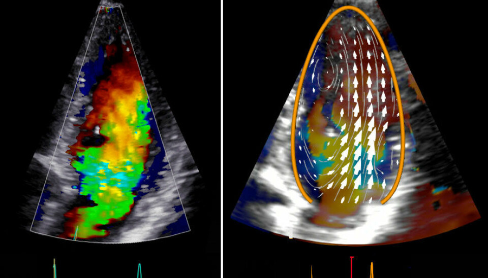 Image of the bloodstream in the left ventricle of the heart, with regular Doppler technology to the left side, and «Blood Speckle Tracking» to the right side.