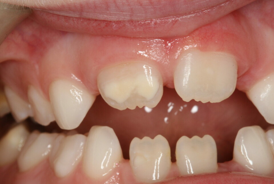 Does your child have spots like these on their front teeth? They indicate an enamel defect. This needn't be a problem if it's only on the front teeth, but if the molars are damaged, pain and fear of the dentist can ensue.