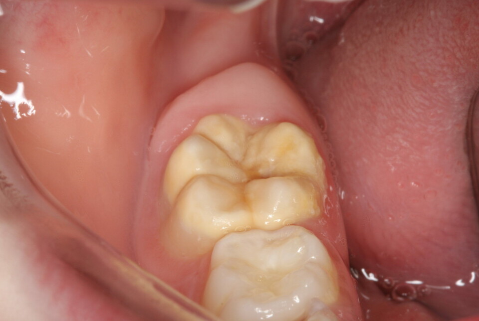 Teeth with enamel defects cannot withstand even light pressure. Here the crown itself is still intact, but the molar is yellowish brown. This means that it contains too few minerals and is weaker than healthy teeth.