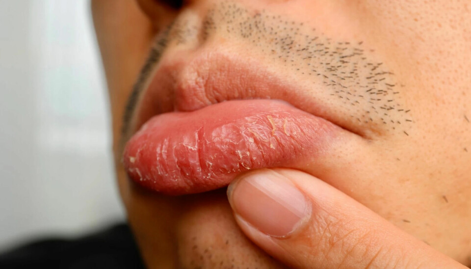 Close up of a man pointing to his dry and cracked lips.
