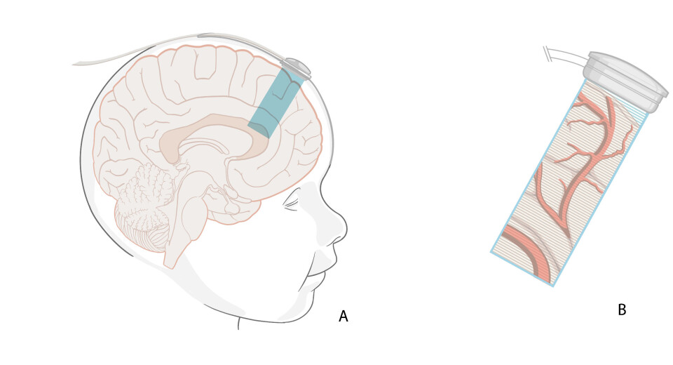 The probe measures the speed of blood flow in large and small blood vessels. The ultrasound waves are sent 3-4 centimetres down into the brain and come back as images that the doctors can see and interpret on a screen.