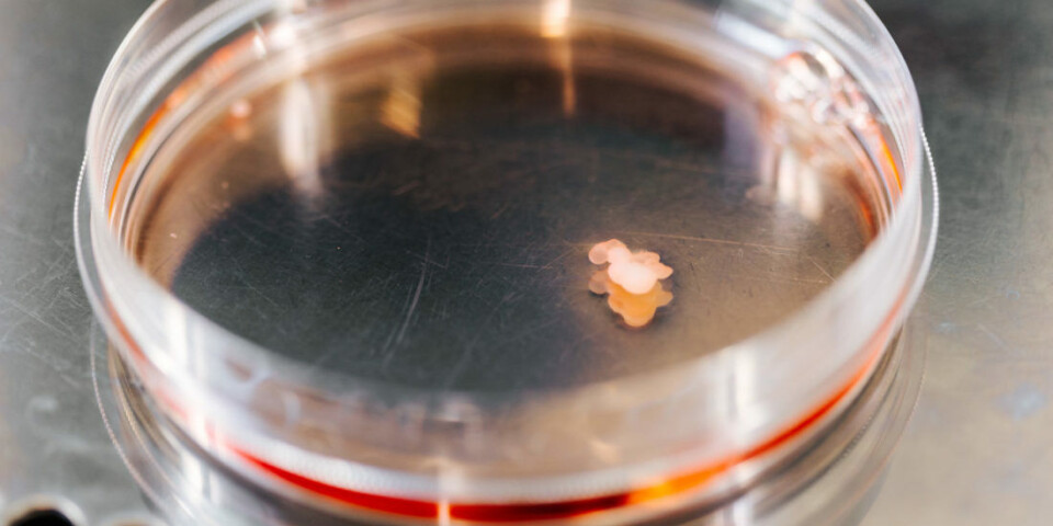 Researchers create mini-brains from skin cells in the lab. The mini-brains are used to test out medicines and gene therapy. The work has provided new knowledge and ideas for the treatment of patients with childhood dementia, Alzheimer's, ALS, Parkinson's, and DOOR syndrome.