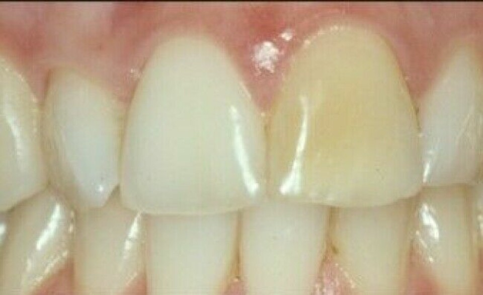 A tooth with a traumatic injury before whitening…