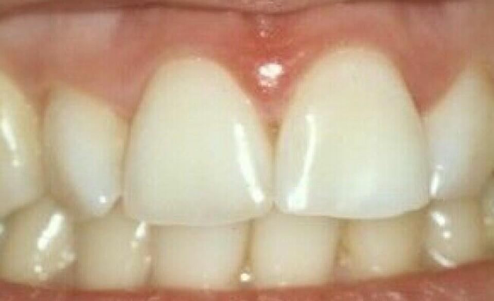 This teeth whitening was done because the patient had a damaged tooth.