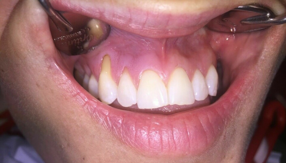 A 20-year-old woman who uses snus daily. Her gums are receding atop her canine tooth on the left of the picture.