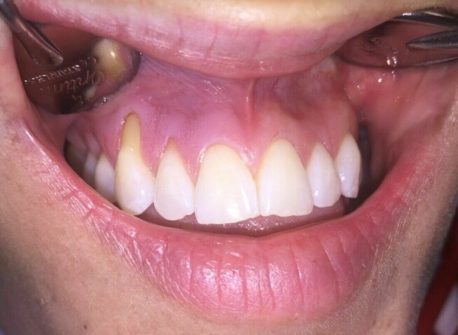 What is snus? And what is the impact on oral health?