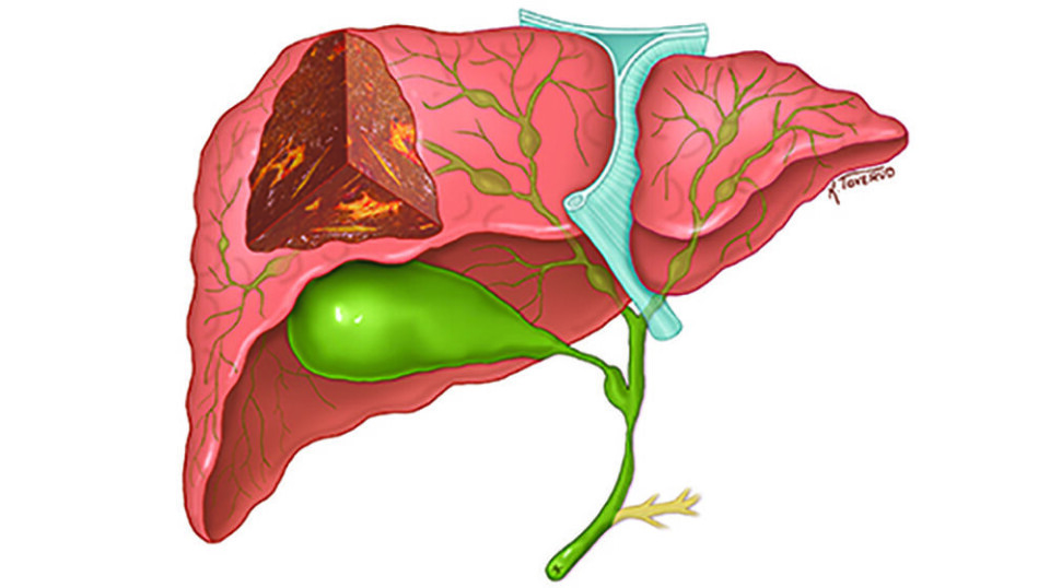 This liver disease is characterised by inflammation in the bile ducts, which is a system of tubes both in and around the liver (in green). The bile ducts carry bile from the liver to the small intestine. The inflammation causes scar tissue to form in the bile ducts, making them narrow. This leads to a build-up of bile that gradually causes serious liver damage.