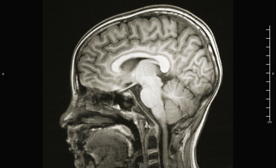 The brain does not exist in isolation; it is bathed in a clear liquid called cerebrospinal fluid. Et MR-bilde av et hode. Hjernen har lysere farge og aller lysest er det innerst i hjernen og i et omriss rundt hjernen.