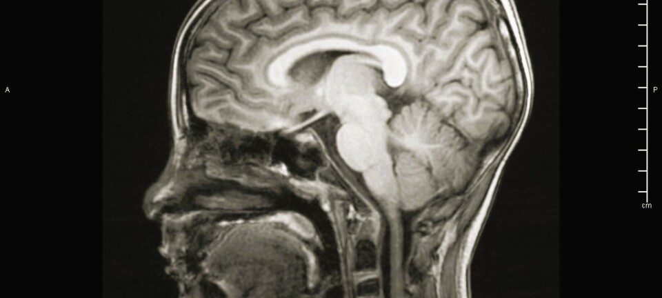 How is the brain cleansed? Researchers are divided over the findings of a new Norwegian study