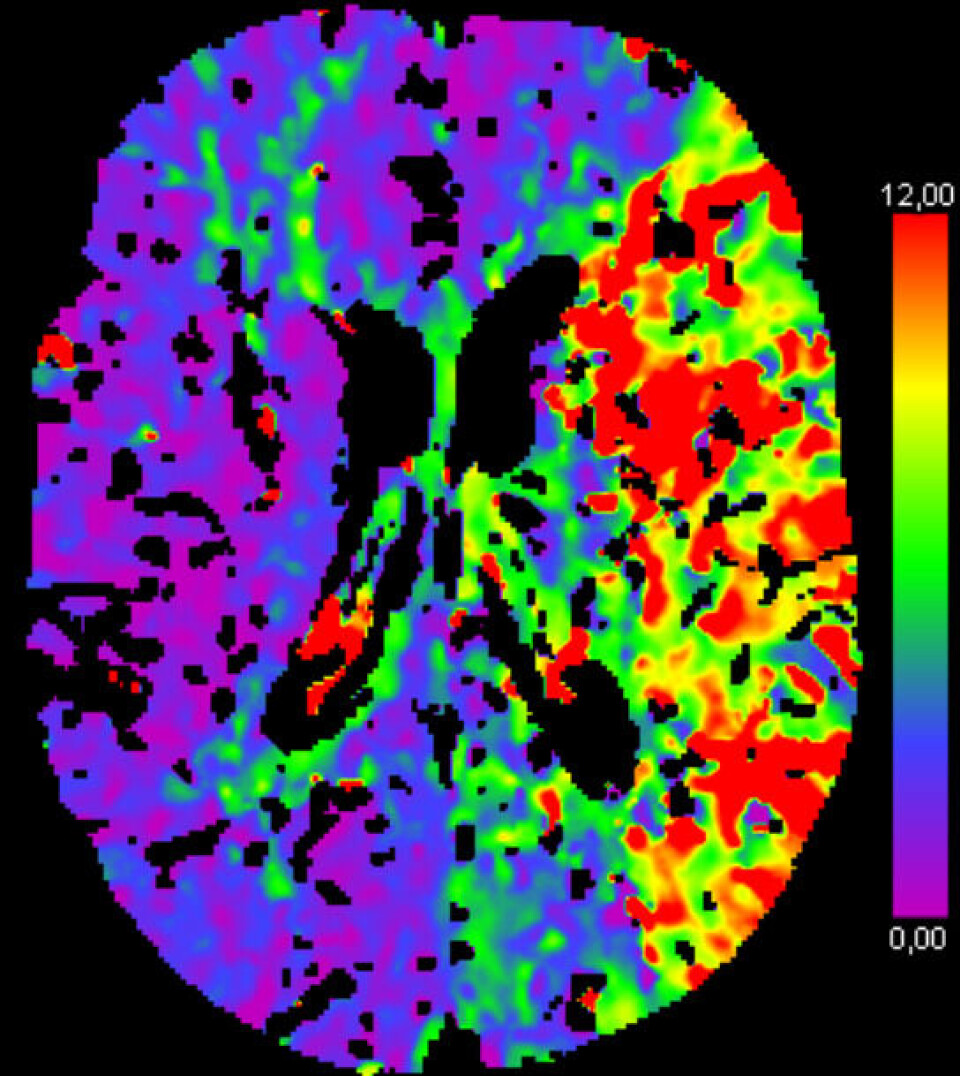 Image based on CT perfusion showing an area with reduced blood supply after a stroke (left hemisphere). CT-bilde av hjerne