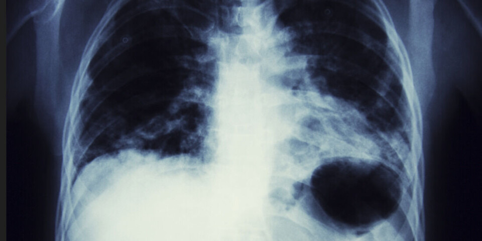 An X-ray image of a patient with lung cancer. Researchers have recently developed a nanomedication that is delivering very promising results.