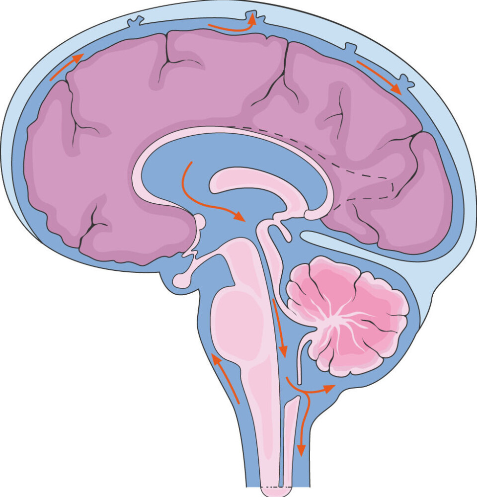 If a blood vessel bursts between the meninges, the normally clear cerebrospinal fluid that surrounds the brain becomes filled with blood. Illustrasjon av hjerne omringet av vann