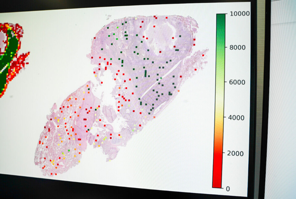 The image shows how the AI system has randomly selected small parts of a whole slide image which contain tumour-infiltrating lymphocytes. KI-bilde av lungevev