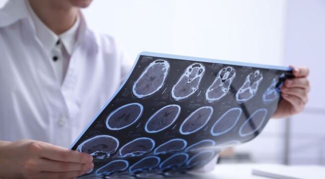 Researchers want to find out if viruses are behind diseases in the brain