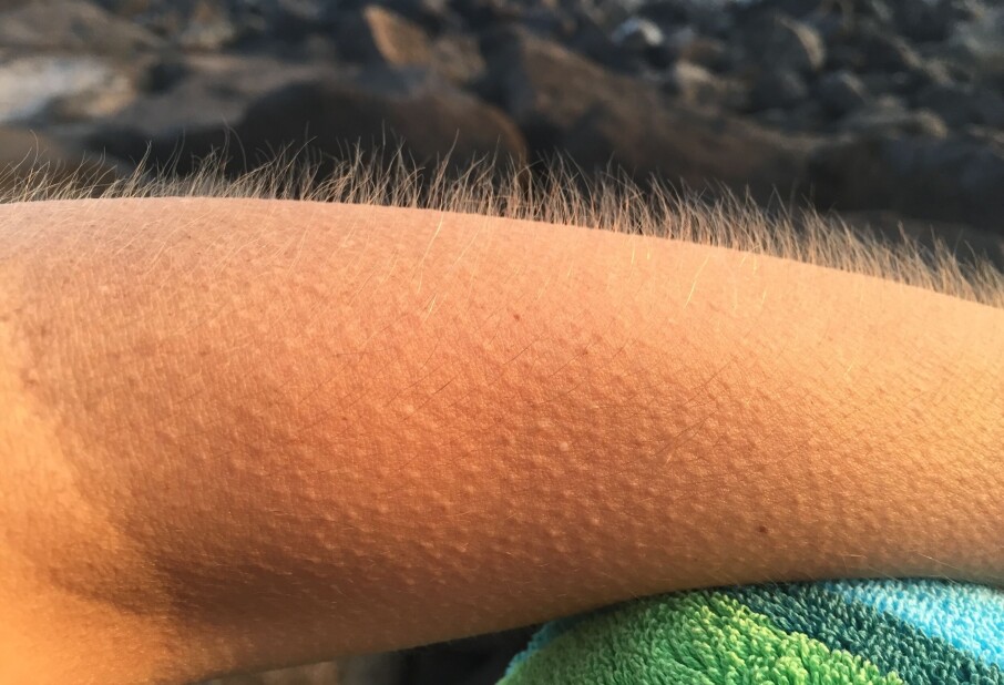 Why do we get goosebumps? 'A reminder that we're animals'
