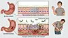 Medical illustration of healthy and ulcerated stomach lining with Helicobacter pylori and pain symptoms.