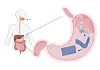 Medical illustration showing a capsule dissolving and unfolding inside the stomach.