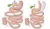 Illustration showing two medical diagrams of the stomach and intestines following gastric bypass and gastric sleeve.