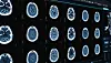 Multiple brain scan images displayed on a medical monitor during an fMRI study.