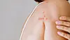 Close-up of several red bed bug bites in a row on a person’s shoulder.