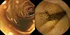 Two round endoscopy images of the inside of the intestine in brown and golden tones.