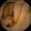Circular endoscopic view of folded tan intestinal tissue and a narrow passage.